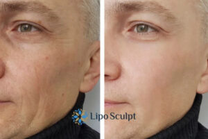 How to Fight Aging Symptoms 3 Fight Aging Symptoms Tring With HIFU and Morpheus8 Today!