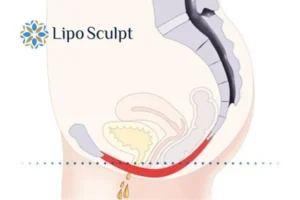 Pelvic Floor Chair Therapy 1 Pelvic Floor Chair Therapy Tring to treat incontinence.