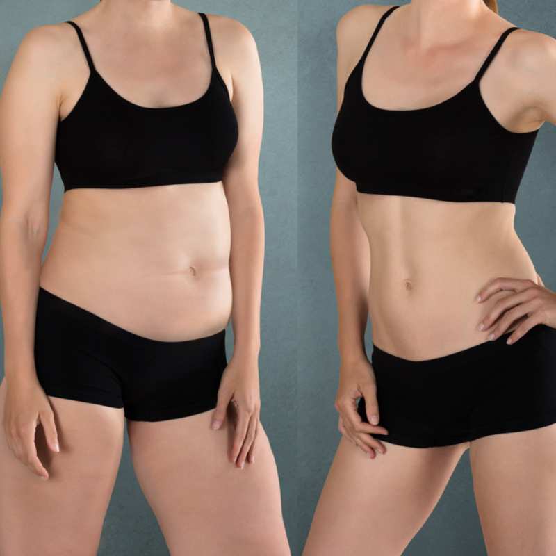 Does Fat Freezing at Home Work? DIY Devices vs Professional Cryolipolysis 2 before and after Cryolipolysis Tring