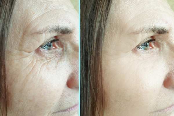 Why Do People Choose HIFU for a Non-Surgical Facelift? 4 How long can HIFU results last Tring?
