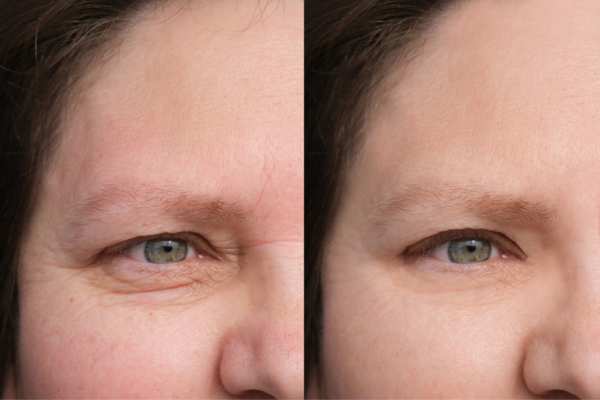 HIFU vs Botulinum Toxin: Understanding the Differences 4 How long do HIFU results last Tring?