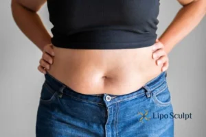 Bidding Farewell to Muffin Tops with Aqualyx Fat Injections 2 Do you wish you could reduce your muffin top Tring With Aqualy fat dissolving injections you can!