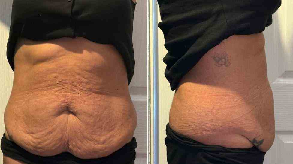 Lost the Weight but Not the Loose Skin? What You Should Know 1 Is It Definitely Loose Skin Tring?