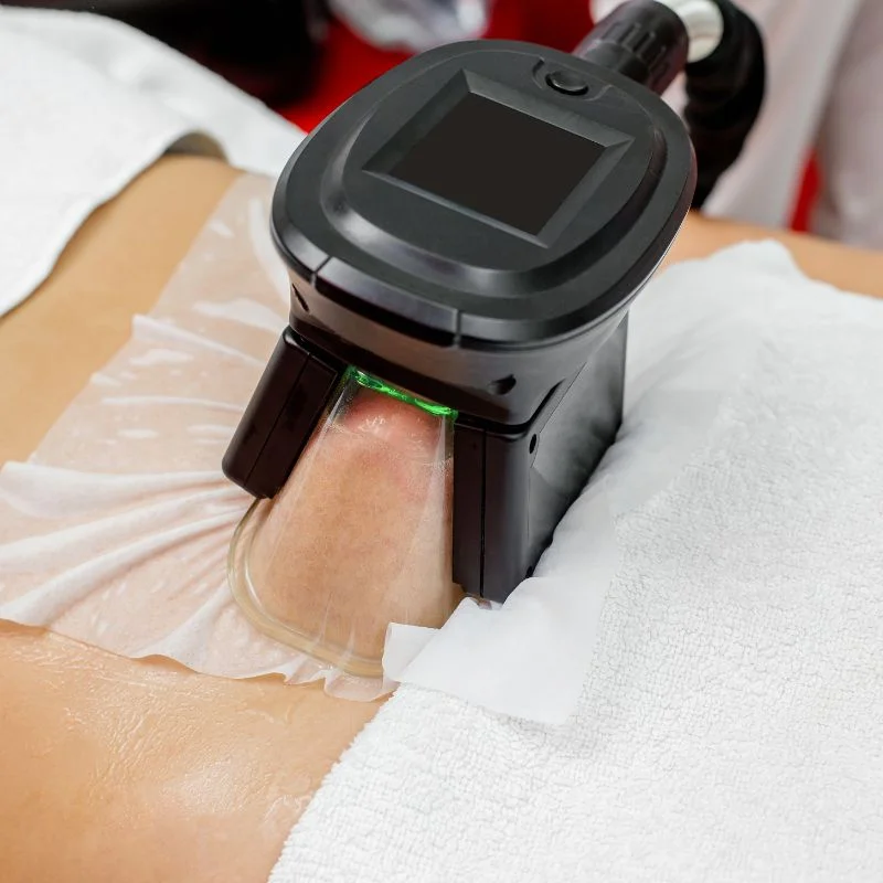 Fat Freezing treatment Tring